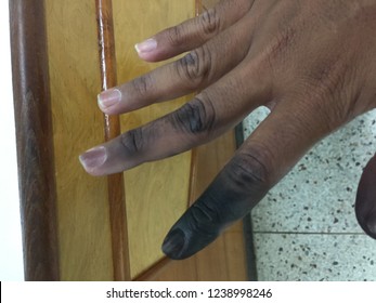 Causes Of Electrical  Shock, Finger Burn