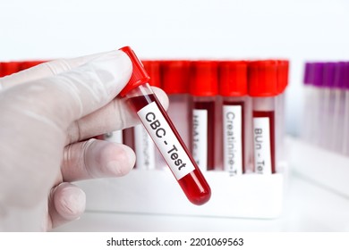 Cbc Test Abnormalities Red Blood Cells Stock Photo 2201069563 ...