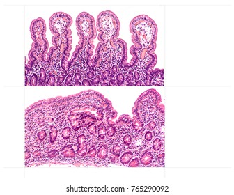 Celiac Disease (sprue, Gluten Sensitive Enteropathy) Is An Autoimmune Disorder Of The Small Intestine With Diarrhea, Bloating. Normal Long Villi (above) Vs Celiac Disease (below) With Blunted Villi. 