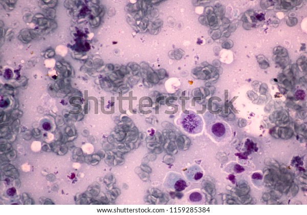 Cell mitosis appearance\
and squamous epithelial cells of cervical human view in\
microscopy.Cytology malignant criteria from pap smear.Medical\
background concept.