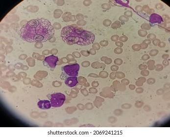 Cells Of Acute Lymphoblastic Leukemia. Human Bone Marrow.