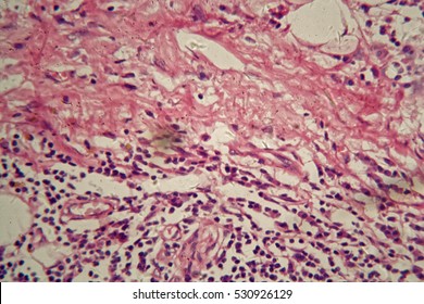 Cells Of A Human Stomach Wall With Stomach Cancer Cells.