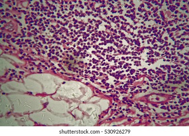 Cells Of A Human Stomach Wall With Stomach Cancer Cells.