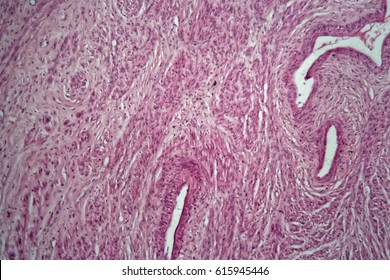 Zellen eines menschlichen Uterus mit uterinen Fibroiden unter dem Mikroskop.
