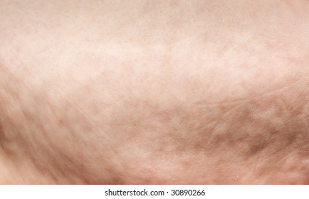 Cellulite Extreme Closeup On Mature Woman Skin