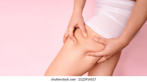 Cellulite leg of a woman Experience the treatment of fat thighs. Overweight liposuction. place for text.