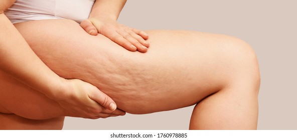 Cellulite leg woman pinch. Test fat hips treatment. Over weight liposuction. Remove striae. - Shutterstock ID 1760978885