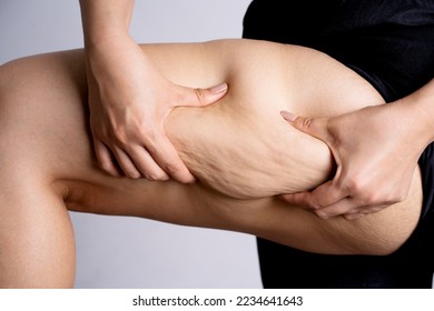 Cellulite leg woman pinch. Test fat hips treatment. Over weight liposuction. 