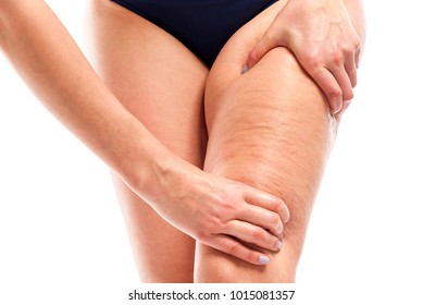 Celulitis en las piernas femeninas. Silueta femenina de fondo blanco.