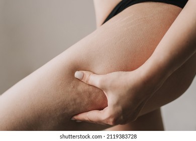 cellulite on the skin close up - Shutterstock ID 2119383728