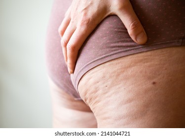 cellulite or orange crust on  feet. Reducing overweight and struggle with cellulite, subcutaneous fat deposition - Shutterstock ID 2141044721