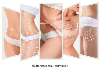 The cellulite removal plan  White markings young woman body