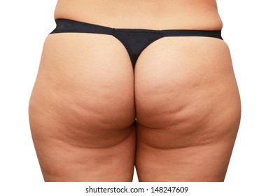 Cellulite Skin At Woman Buttocks 