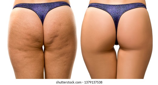 Cellulite Images Stock Photos Vectors Shutterstock