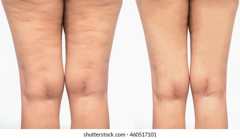 Cellulite  women. Figure of a young girl before and after.