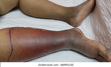 Cellulitis Of Right Lower Limb.