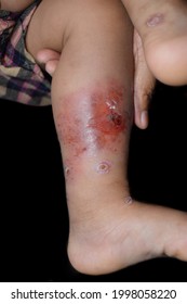 Cellulitis And Staphylococcal, Streptococcal Skin Infection At Leg Of Asian Baby. Swollen And Painful Limb.