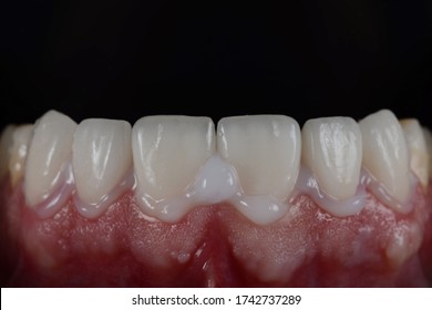 Cementation or bonding procedure of ceramic veneers. Close up intra oral shot of veneer placing and installing on the tooth. 