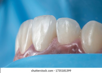 Cementation or bonding procedure of dental ceramic veneers under rubber dam isolation.
