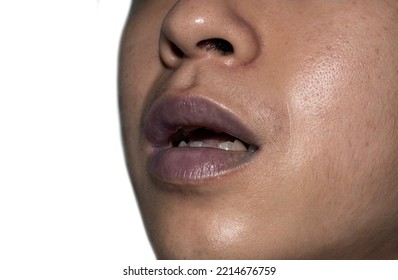 Central Cyanosis In The Lips Of Southeast Asian Young Man With Congenital Heart Disease.