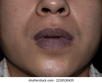 Central Cyanosis In The Lips Of Southeast Asian Young Man With Congenital Heart Disease.