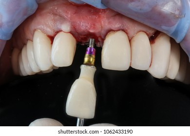 Installation Crown Part Central Tooth Upper Stock Photo (Edit Now ...