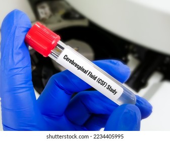Cerebrospinal fluid (CSF) study including biochemistry, cytology, Gram staining. - Shutterstock ID 2234405995