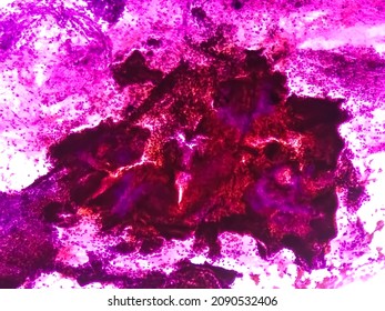 Cervical Cancer Cell, SEM Of Cervical Carcinoma