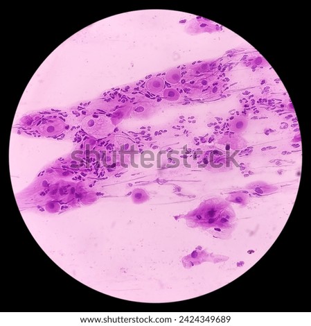 Cervical cancer cells. Atypical squamous cells of undetermined significance(ASCUS), Cancer of cervix, Pap's smear, pap's.