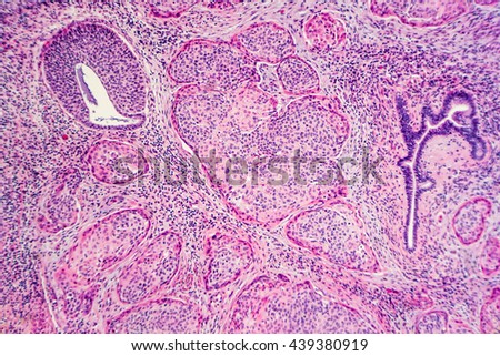 Cervical Cancer Invasive Squamous Carcinoma Arising Stock Photo (Edit ...