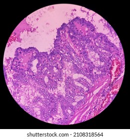 Cervical Lymph Node Cancer: Microscopic Image Of Metastatic Papillary Carcinoma Of Thyroid, Microscopic 40x View.