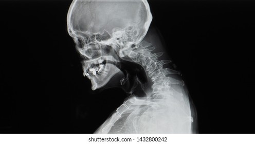 Cervical spine x-ray showing spondylosis with kyphotic deformity of cervical spine. Chin to chest deformity. It cause neck pain, spondylotic myelopathy and radiculopathy. Dropped head syndrome.