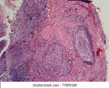 Cervical Squamous Carcinoma Tumor Nests.  Magnification 100x