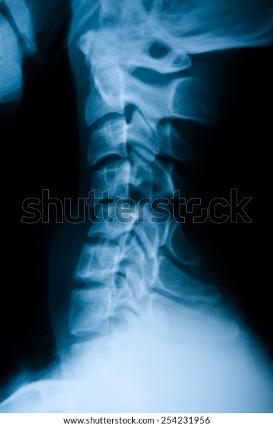 Cervical Subluxation Xray Stock Photo (Edit Now) 254231956