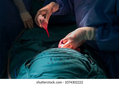 Cesarean Section For New Born Baby In Operating Lab Room. Doctor Using Medical Tool To Absorb Blood From Infant Mouth Before Pulling Baby Out For Mom Belly. Real Operation.