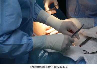 Cesarean Surgery Birth Stock Photo 489239815 