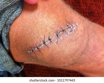 Chainsaw Injury With Sutures 