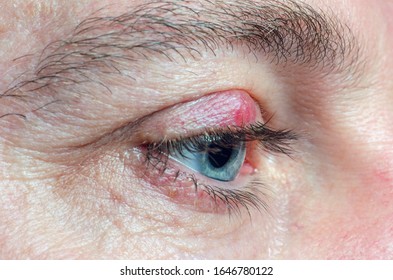 Chalazion Images, Stock Photos & Vectors | Shutterstock