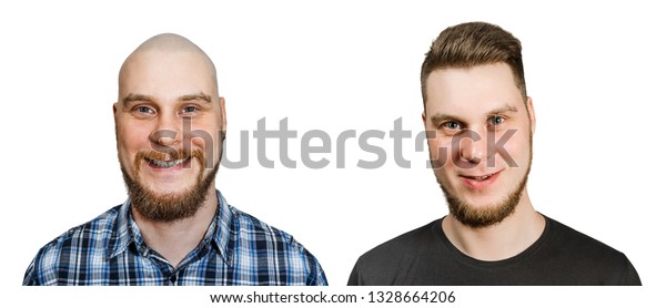 Change One Guy Before After Bald Stock Photo Edit Now 1328664206