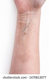 Changes In The Skin Tissue On The Inside Of The Forearm Lichen Sclerosus - Discoloration And Thinning Of The Skin