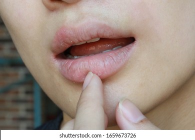 Chapped, Cracked Lips Caused Painful: Dry Skin Problem