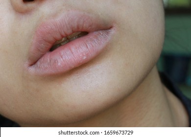 Chapped, Cracked Lips Caused Painful: Dry Skin Problem