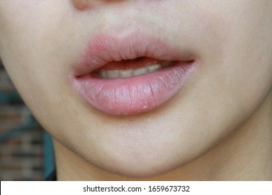 Chapped, Cracked Lips Caused Painful: Dry Skin Problem