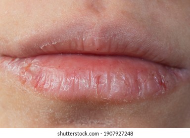 chapped and dehydrated dry lips.chapped lips in winter.Close-up pale female lips cracked - Shutterstock ID 1907927248