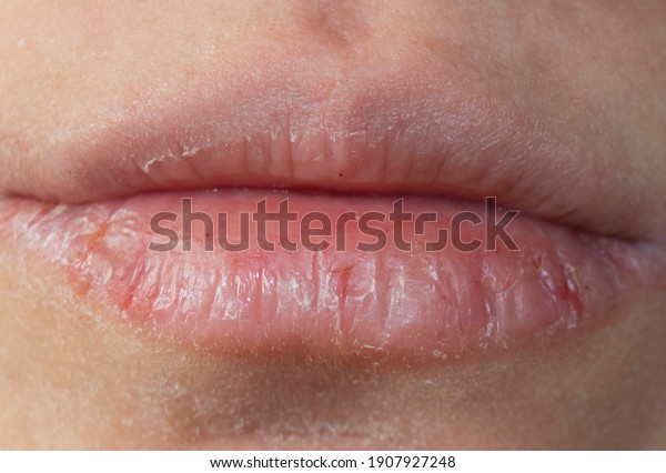 chapped and dehydrated dry lips.chapped lips
in winter.Close-up pale female lips
cracked