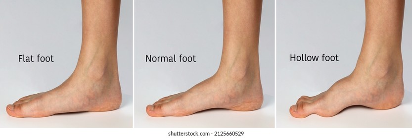 Chart showing forms of foot. Flat shape( fallen arch), Normal healthy foot and hollow shape (high arch) or claw foot isolated on white background.