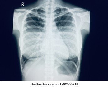 Check Up Chest X-ray A Femal 35 Year Old.Normal And Healthy Chest. 