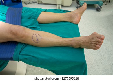 The Check Mark On Right Knee Preparing Patient Before Do The Operation . The Mark Site Reduce And Prevention The Incidence Of Wrong Site Operation . Medical And Patient Safety Concept.  