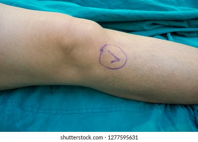 The Check Mark On Right Knee Preparing Patient Before Do The Operation . The Mark Site Reduce And Prevention The Incidence Of Wrong Site Operation . Medical And Patient Safety Concept. 