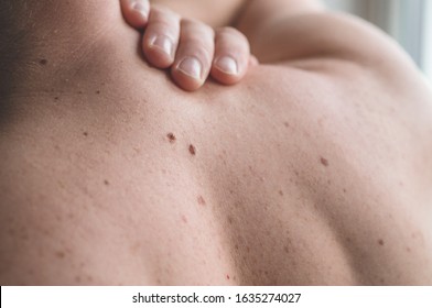 Checking Benign Moles. Close Up Detail Of The Bare Skin On A Man Back With Scattered Moles And Freckles. Sun Effect On Skin. Pigmentation. Birthmarks On Skin